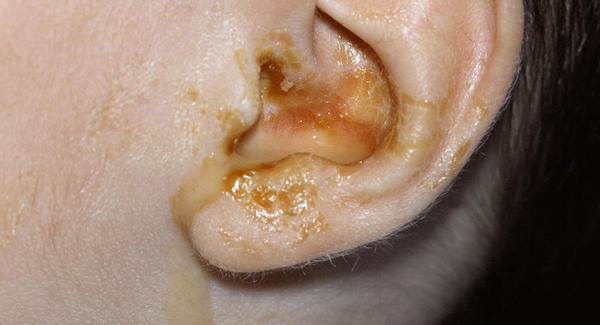 Выделение из уха